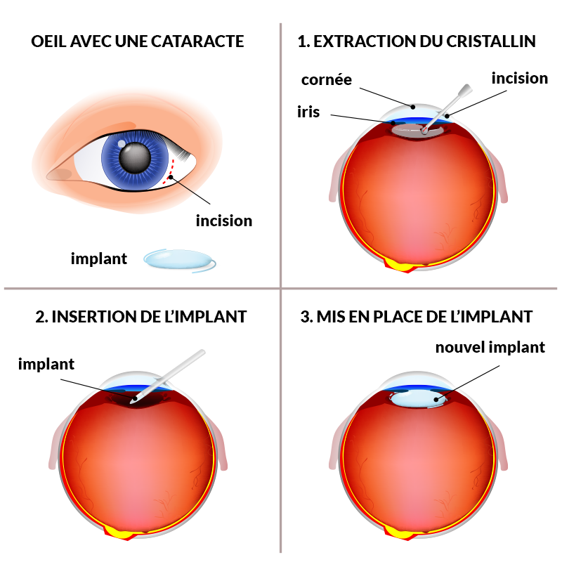 Chirurgie de la cataracte à Saint-Malo • Centre Visiomer